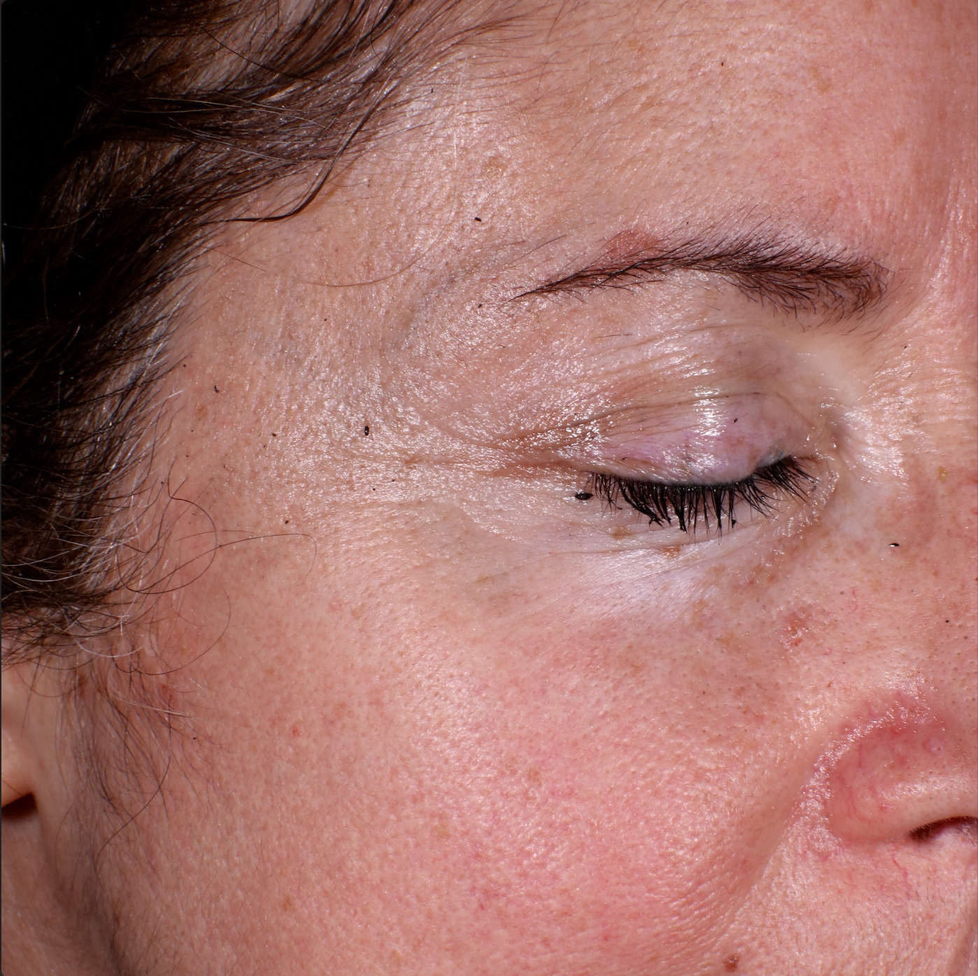 40+ year old woman's skin before treatment Before photo of woman with wrinkles, dark spots, and crows' feet