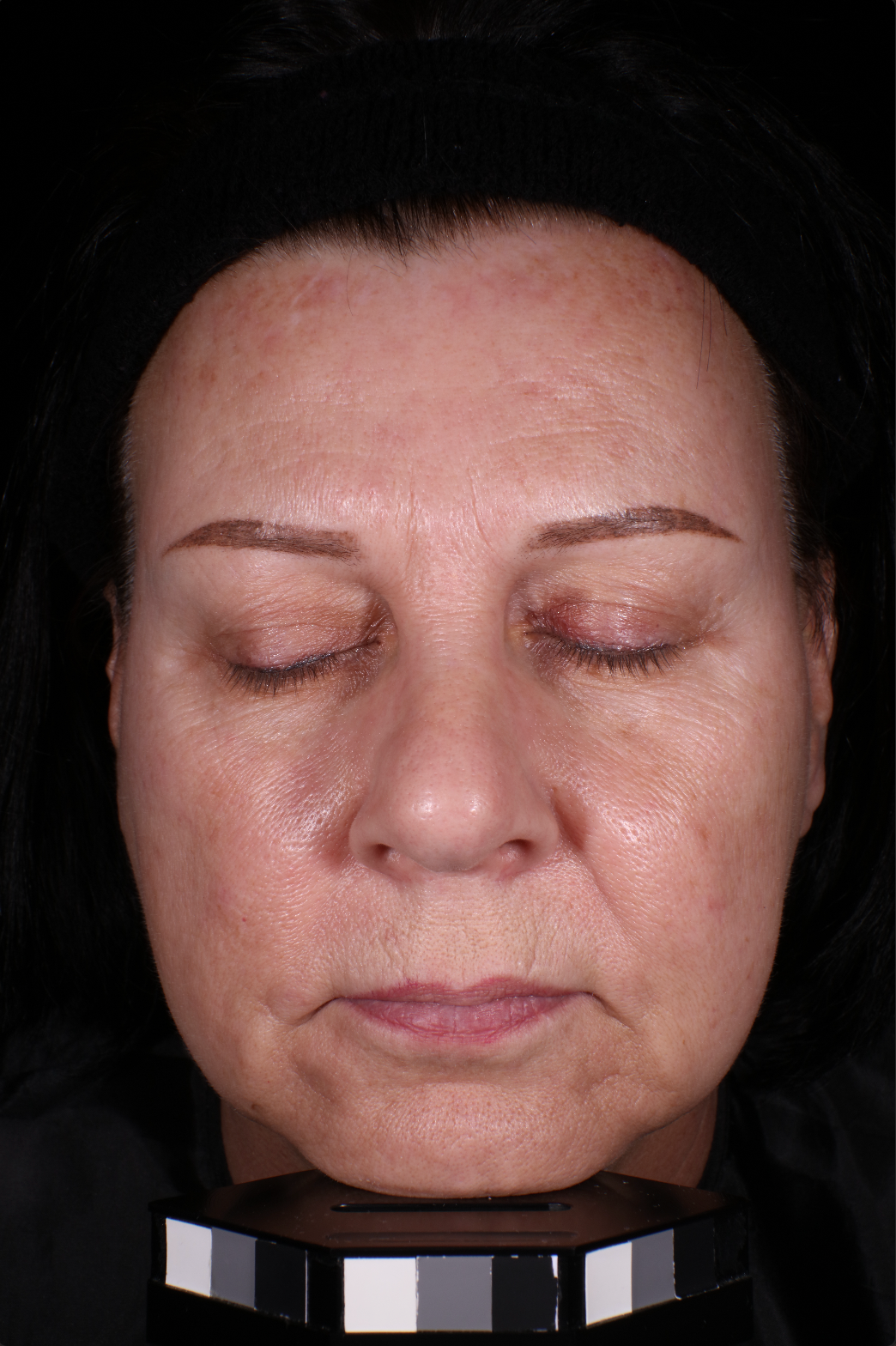 Baseline face photo Woman's face with wrinkles, sagging, and large pores