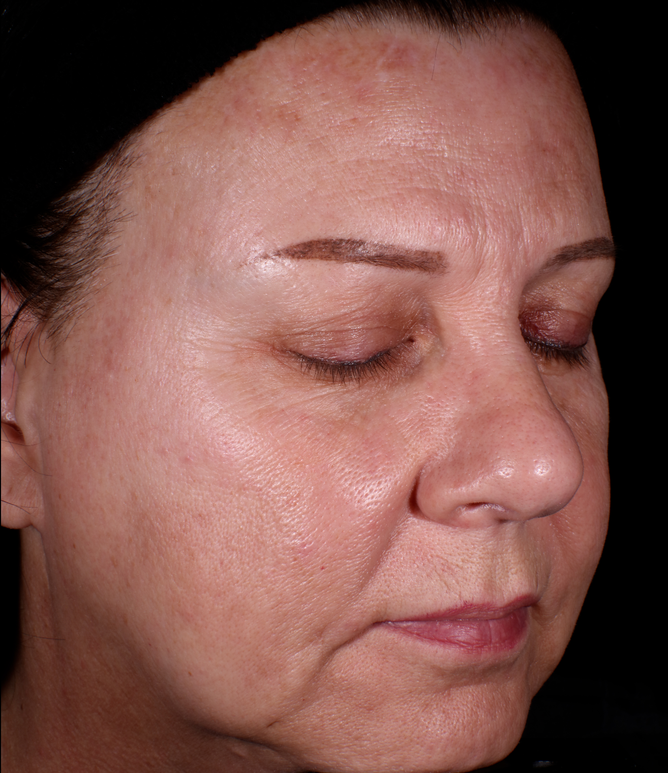 40+ year old woman with skin concerns Before