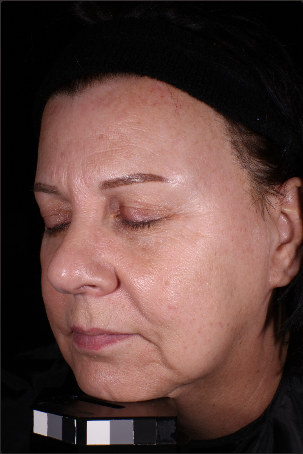 Unretouched clinical photo at Day 0